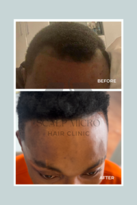 Stanley's Hair Transplant in Ghana results